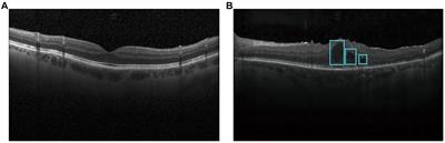 DME-DeepLabV3+: a lightweight model for diabetic macular edema extraction based on DeepLabV3+ architecture